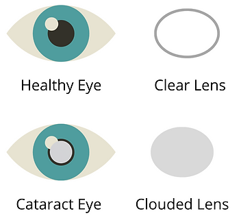 cataracts.png