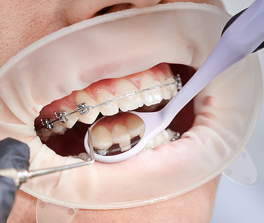 pasang behel surabaya