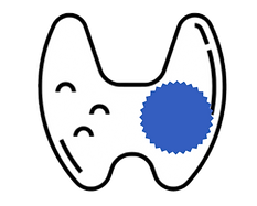 Nodule thyroide