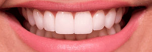 lentes-de-contato-dental_edited.jpg