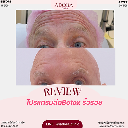 Botox ริ้วรอย