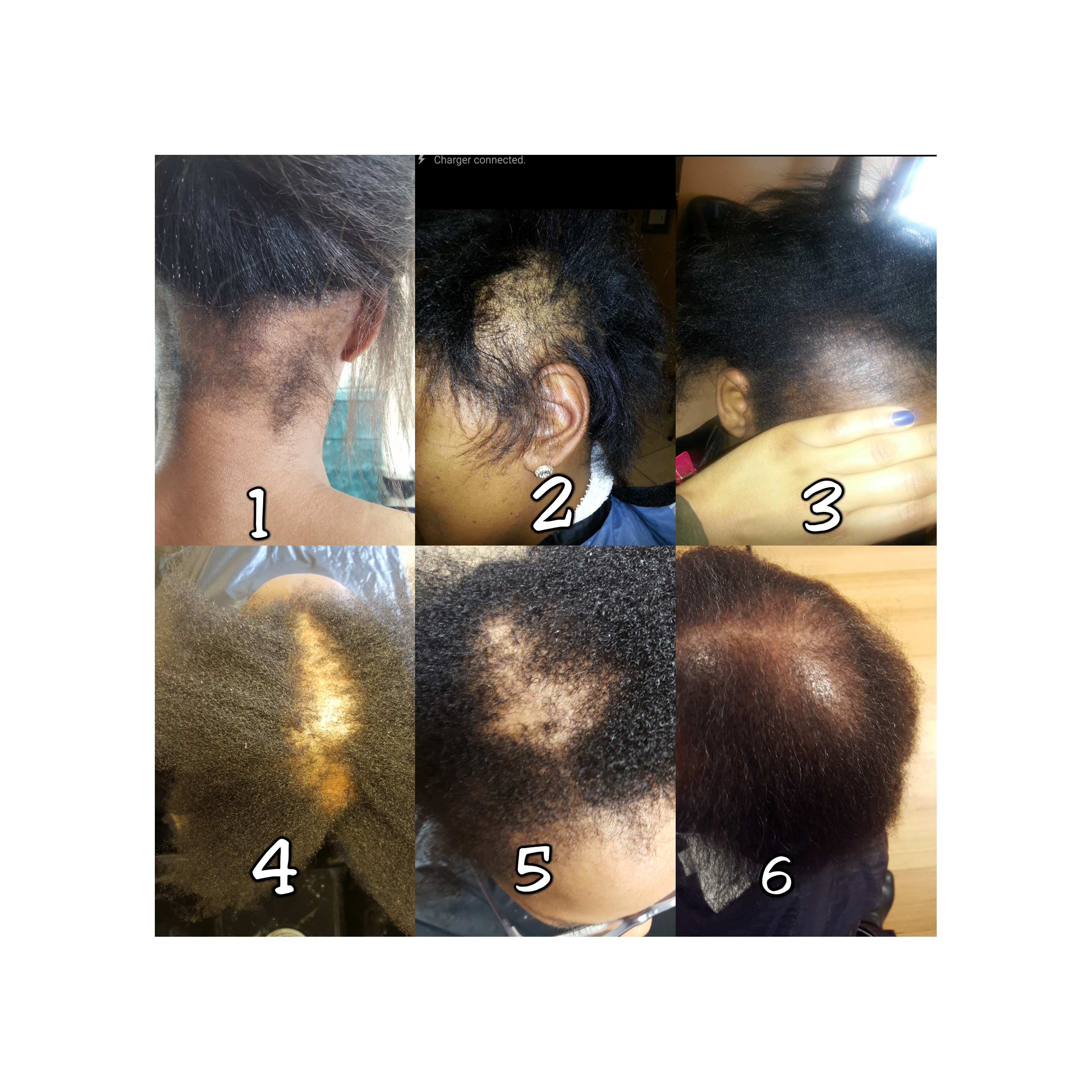 Hair Loss In Black Women The Epidemic