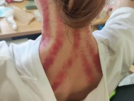 Gua Sha Therapy Benefits – How It Heals Muscles, Fascia, and Circulation Naturally