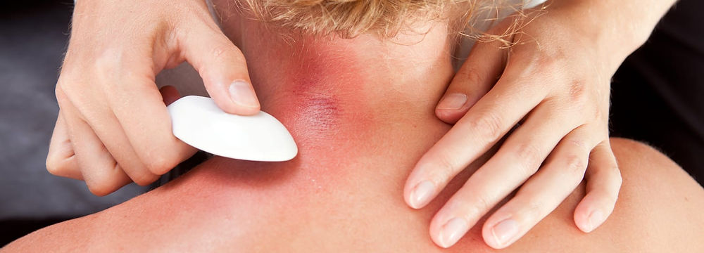 Cupping therapy in Paralimni, Cyprus