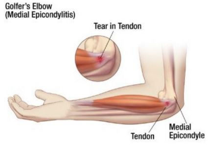 medial-epicondylitis.jpeg