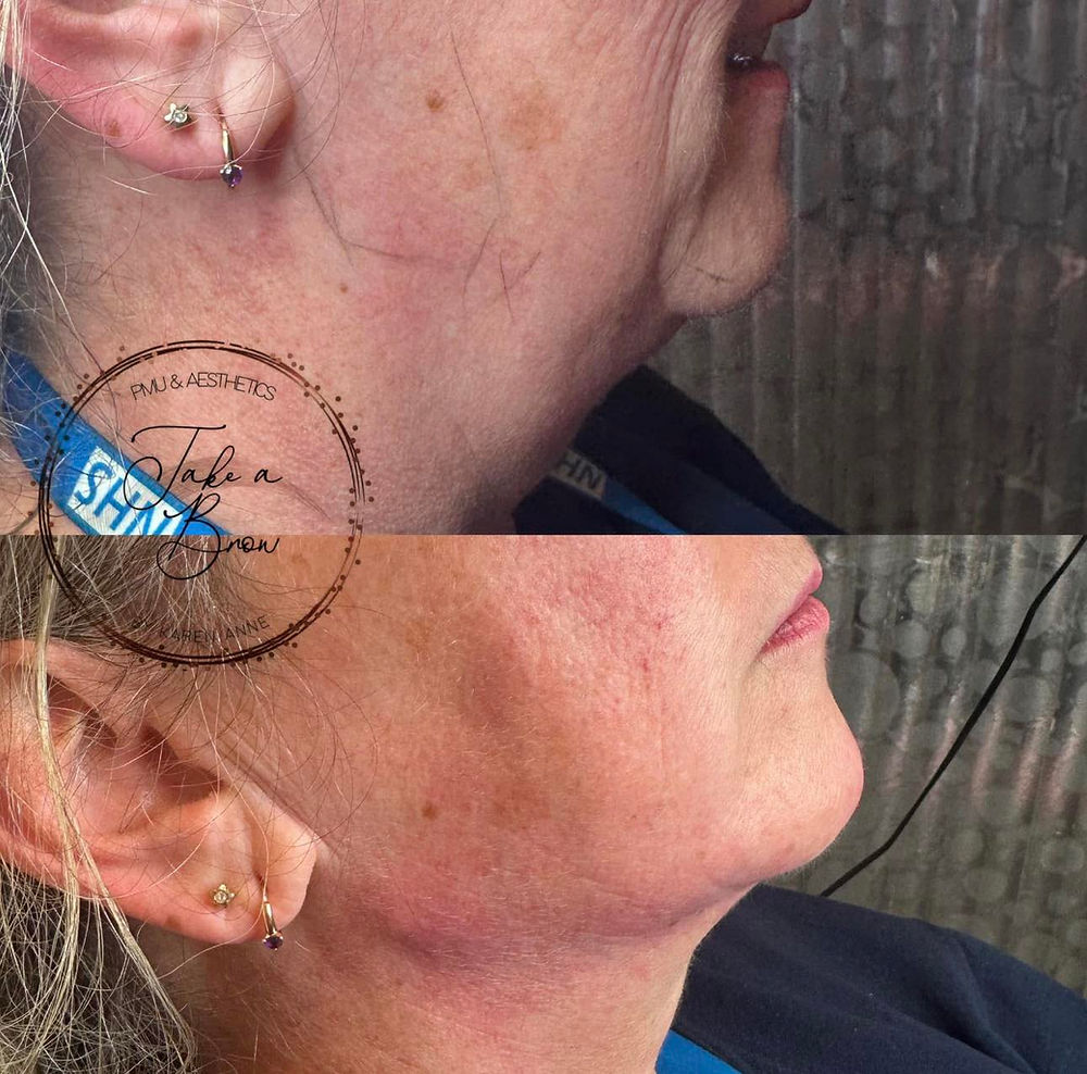 facial filler,