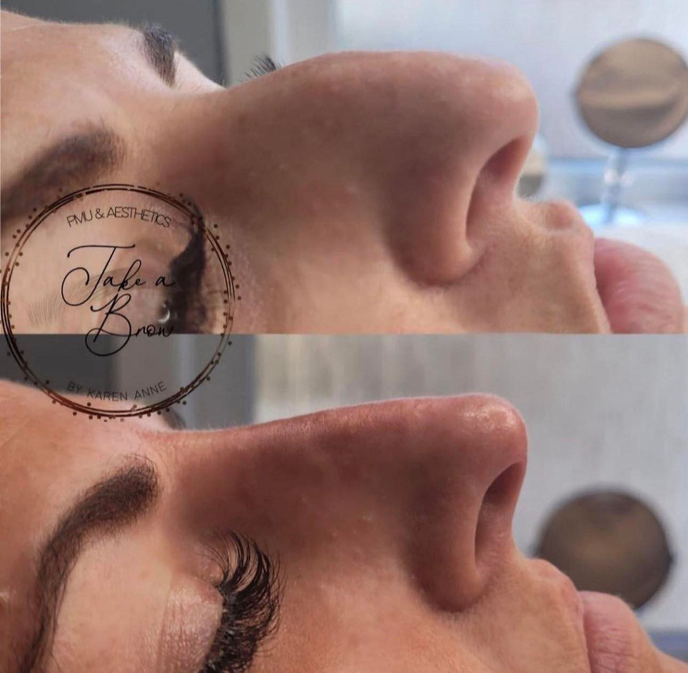 rhinoplasty