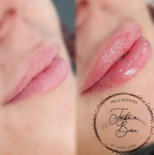 russian lips, russian lip filler