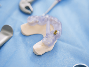 Implante Dentário com Cirurgia Guiada: O Que É e Como Funciona?