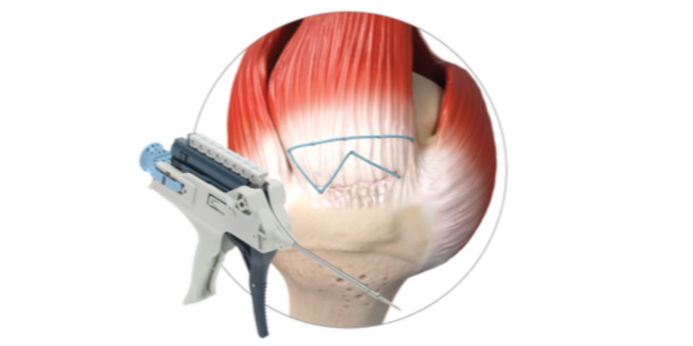 Orthopedic Innovation Spotlight: Tendon Seam