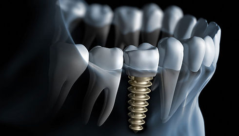 2016-07-29-1469804112-9503073-dentalimpl