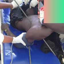 Cameroun : un ouvrier survit après avoir été transpercé par une barre de fer sur un chantier à Douala