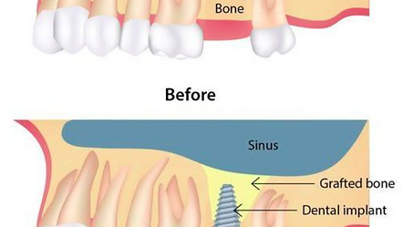 Sinus Lift