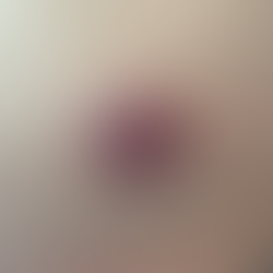 Carcinoma de Células de Merkel: entenda esse câncer de pele raro e agressivo