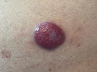 Carcinoma de Células de Merkel: entenda esse câncer de pele raro e agressivo