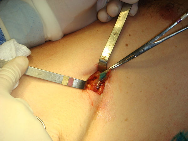 biopsia linfonodo sentinela melanoma cirurgia especialista rio de janeiro