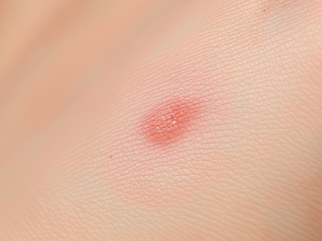 Lesão que sangra: quando se preocupar com câncer de pele?