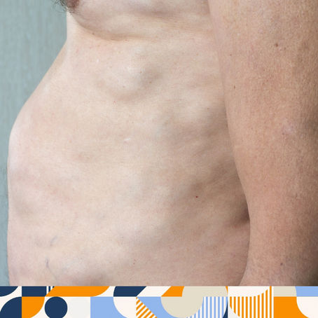 Lipomas, Nevos e Outros Tumores Benignos: O Que Você Precisa Saber