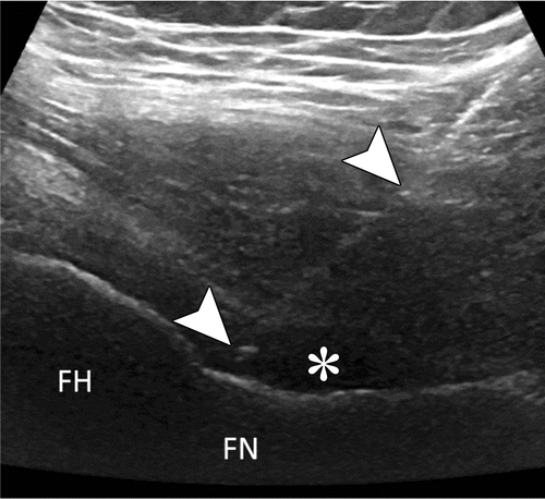 Ultrasound For The Lower Extremity: Sonoanatomy and Guided Interventions