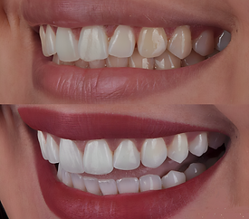 عدسات الإيماكس