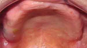 Before photo full upper denture