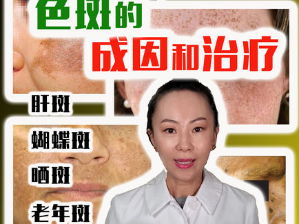 丽之林医学美容中心 ——了解色斑的种类,如何有效祛斑?【洛杉矶医美】