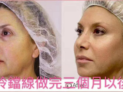 铃铛线线雕——面部逆生长，就选铃铛线！【洛杉矶医美】