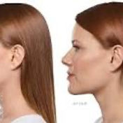 kybella1.jpg