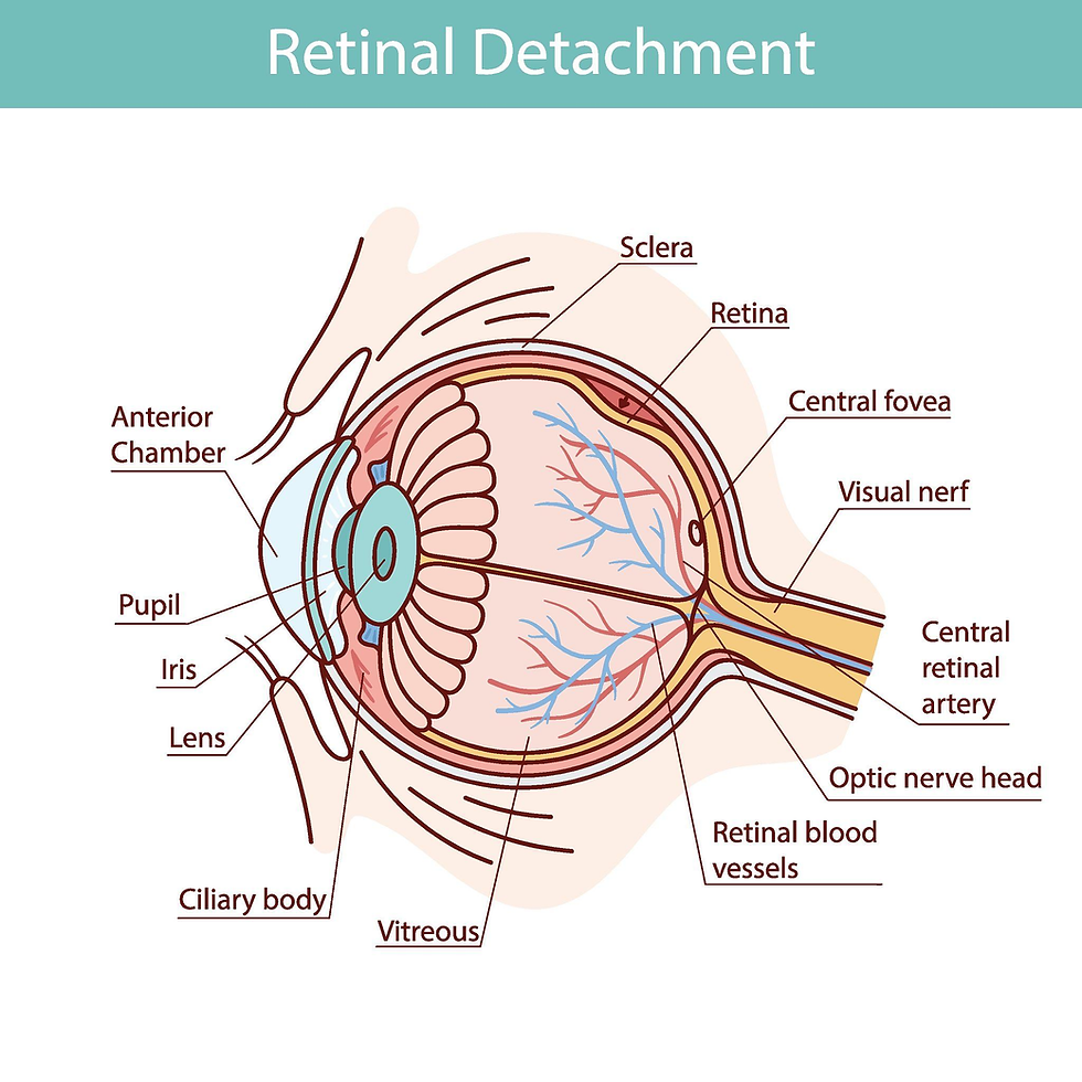 Ilustração da tração do vítreo sobre a retina causando flashes de luz.