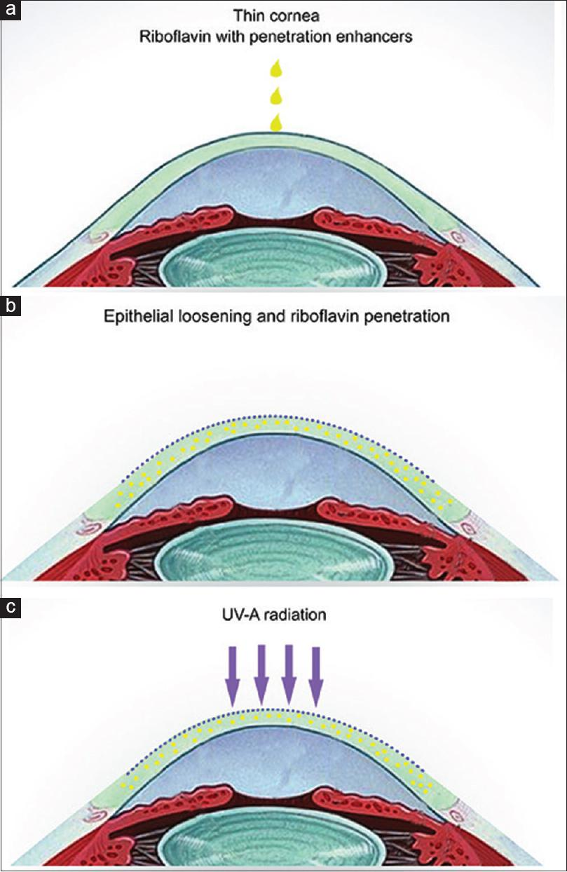 Procedimento de crosslinking utilizado para estabilizar o ceratocone.