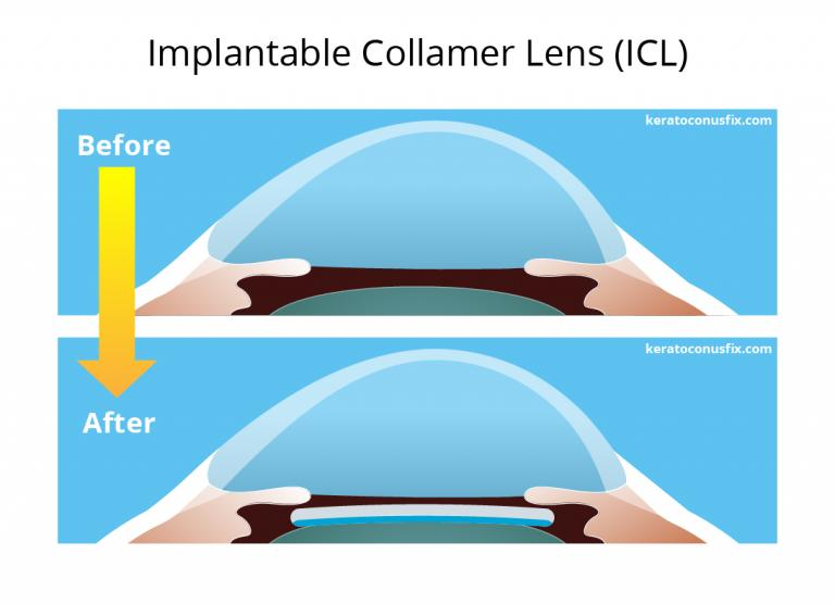 Ilustração da lente fáquica implantada no interior do olho
