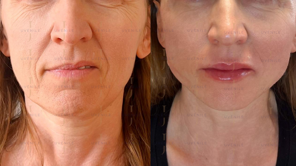 Fadenlifting_Juvenile_Wien