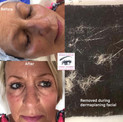 Dermaplaning Results