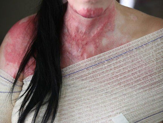 Homem coloca fogo em esposa no interior de Mato Grosso.