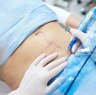 Narbenretuschierung einer Narbe am Bauch