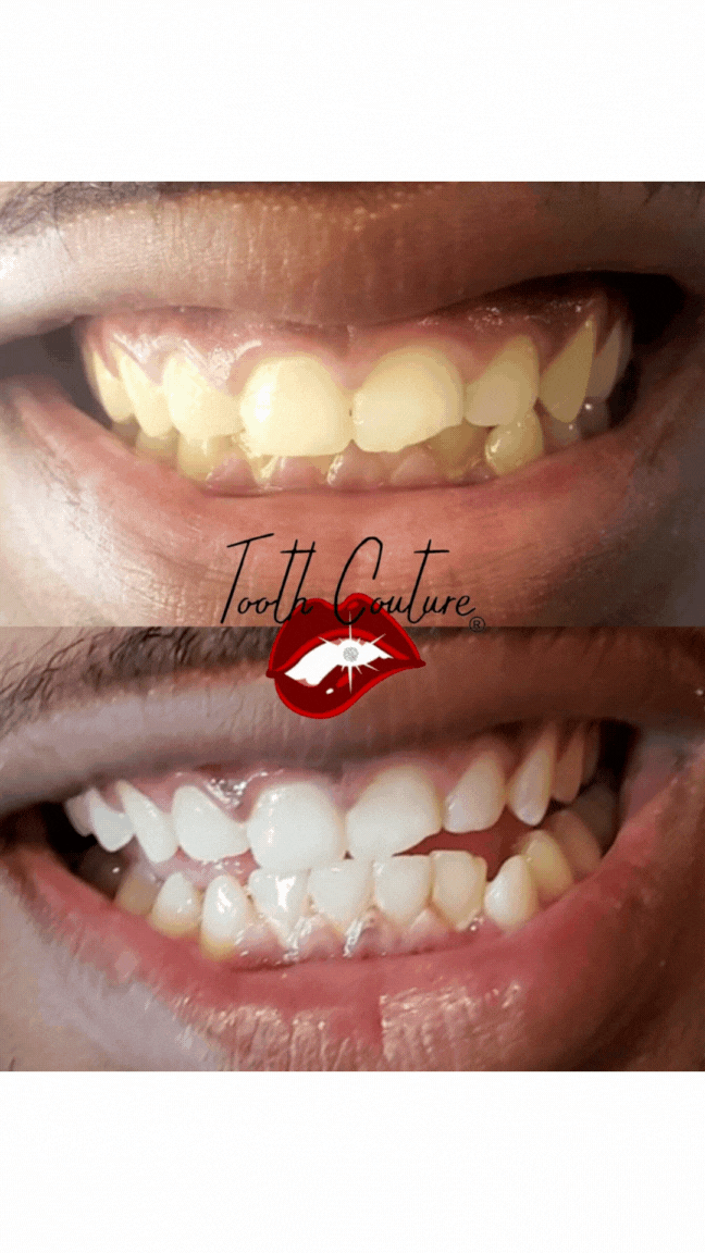 TC Teeth Whitening.gif