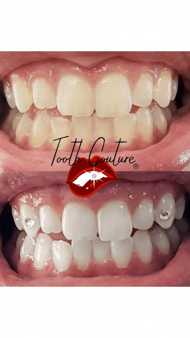 TC Teeth Whitening + Gems.gif