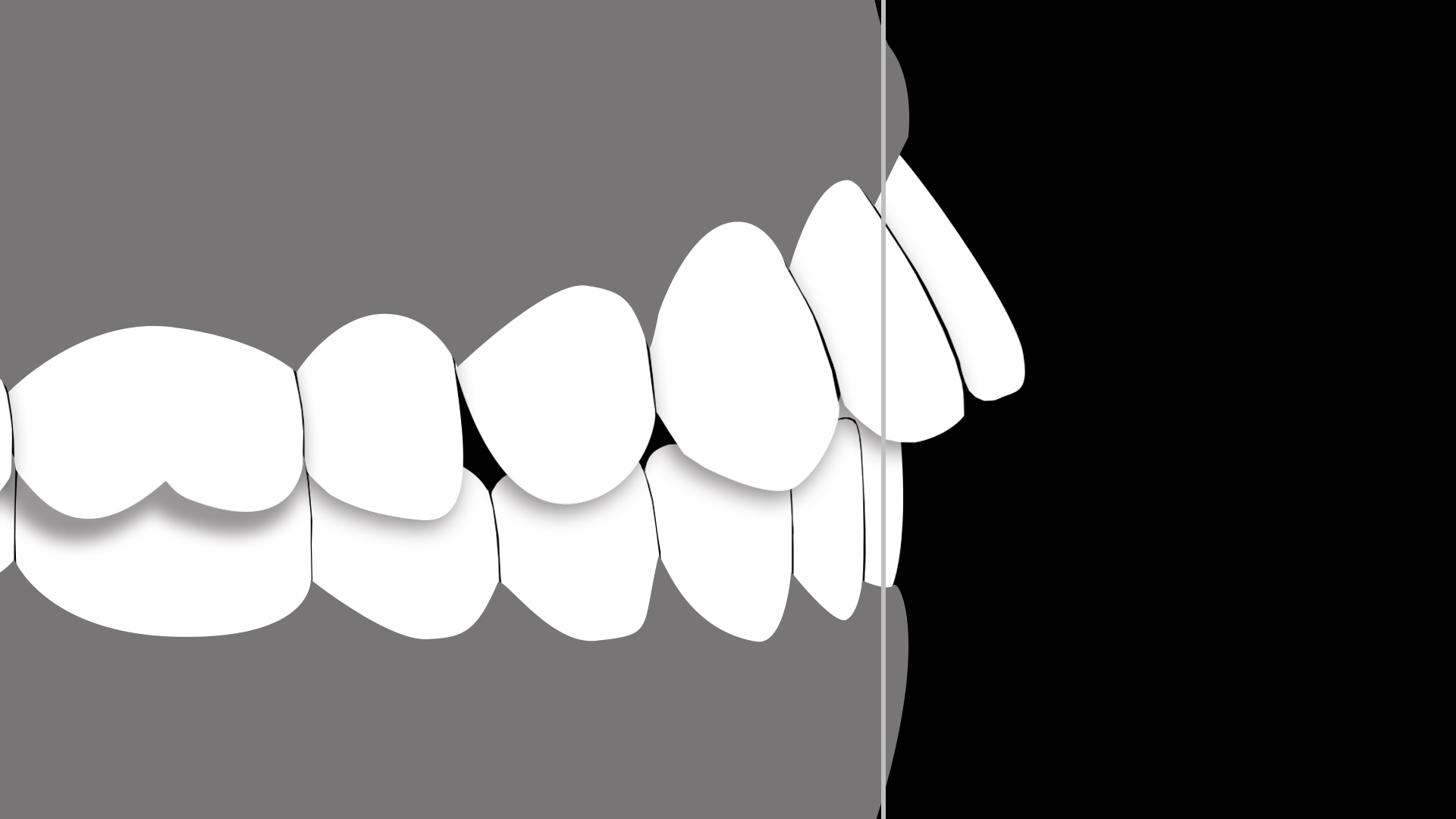 Protrusion Mid.gif