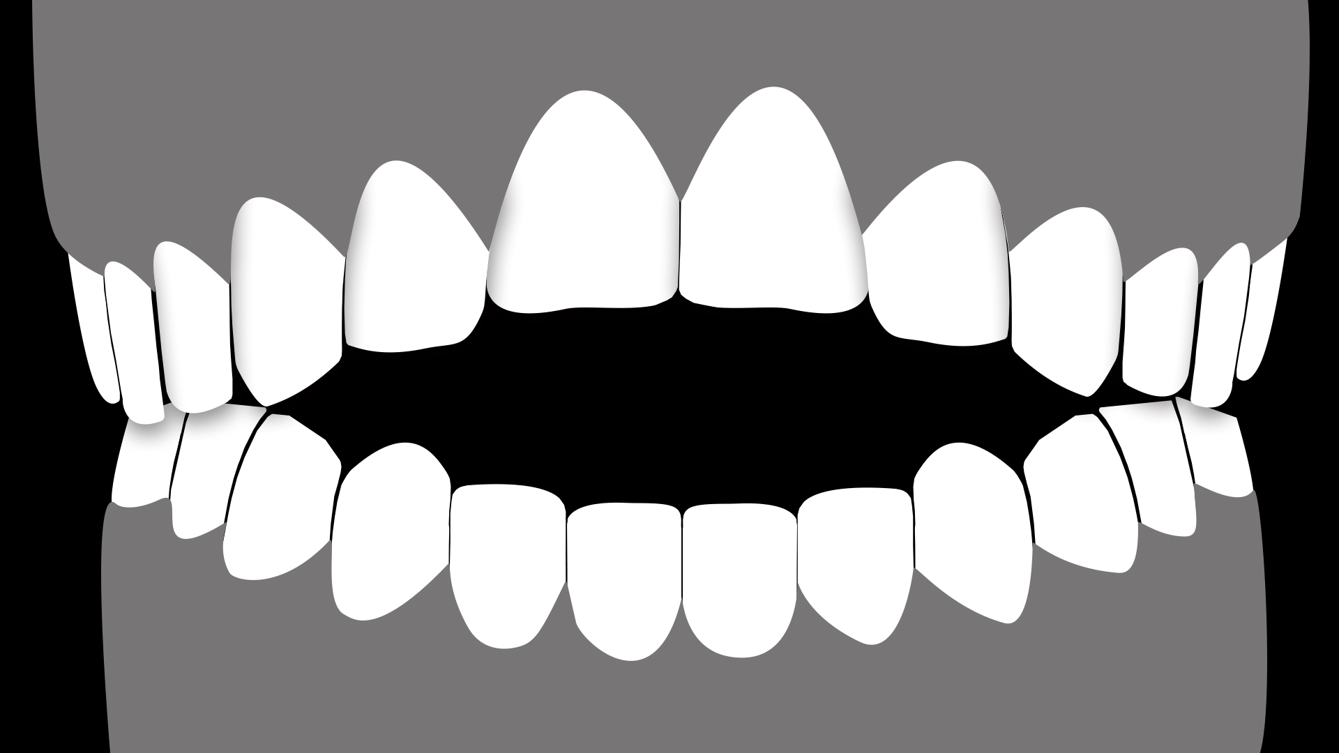 Open-bite 적용힘든사례.gif