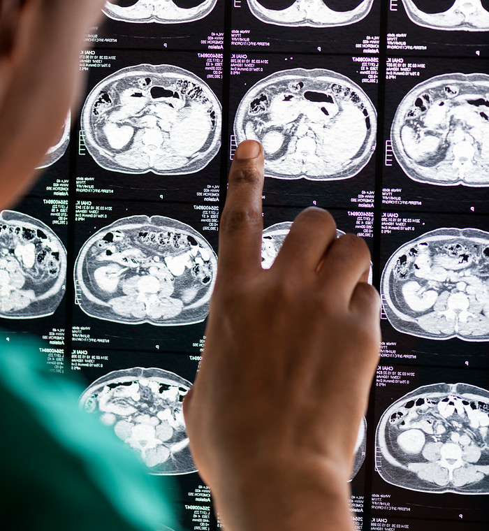 Cirugía de migraña