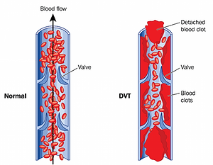 deep-vein-thrombosis