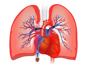 pulmonary-embolism