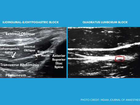 Quadratus Lumborum Vs Ilioinguinal