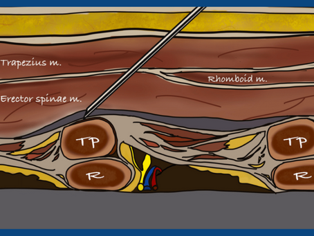 Discover the Versatility of Erector Spinae Plane Block!