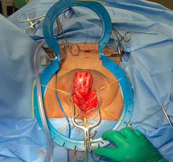 uretroplastiacaso1Captura de Pantalla 2023-01-02 a la(s) 22.26.17.jpg