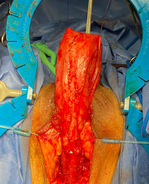 uretroplastiacaso2Captura de Pantalla 2023-01-02 a la(s) 22.50.30.jpg