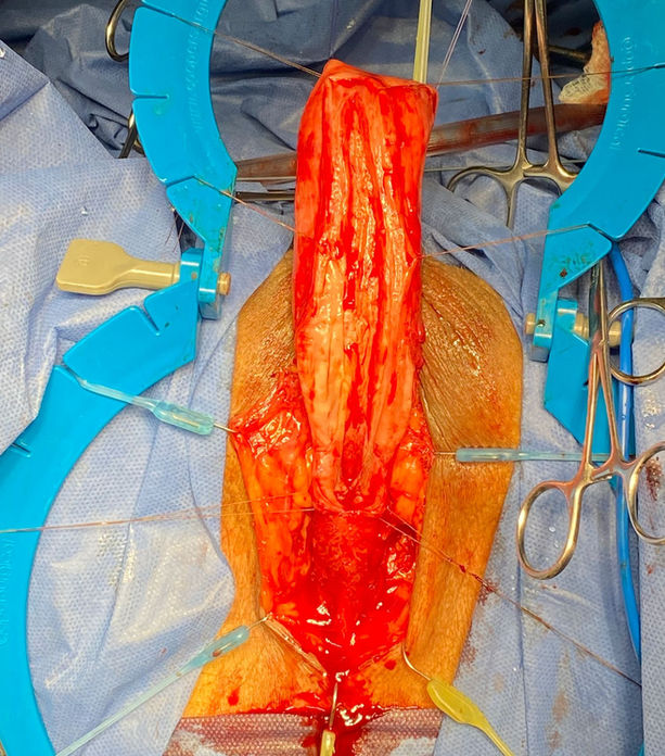 uretroplastiacaso2Captura de Pantalla 2023-01-02 a la(s) 22.49.56.jpg