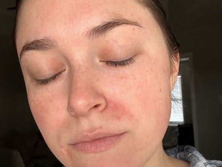 How Natural Skin Care Has Been Healing My Dermatitis