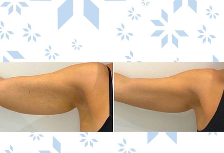 Fat Freezing Arms