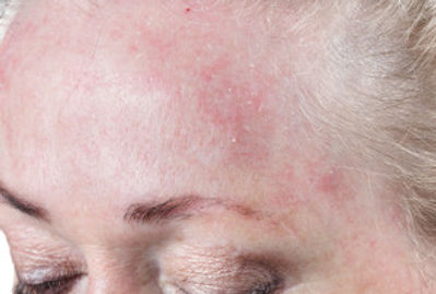 rosacea on the forehead